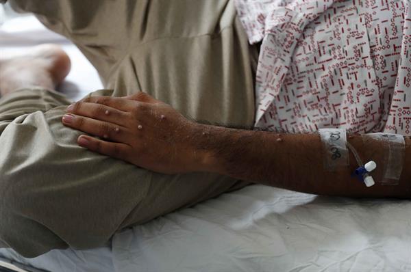 Fotografía de archivo de un paciente al ser atendido tras ser diagnosticado con la viruela del mono. EFE/Paolo Aguilar